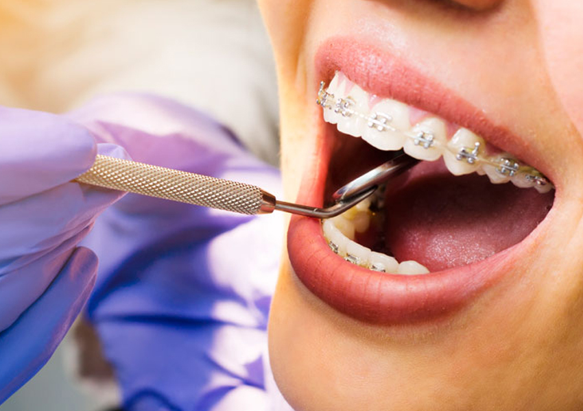 Diş Teli Lastiği Nedir? Diş Teli Lastiği Nasıl Takılır?